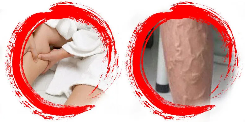 Пластырь от варикоза Чжао Цзюньфэн предотвратит варикозную экзему и тромбофелит