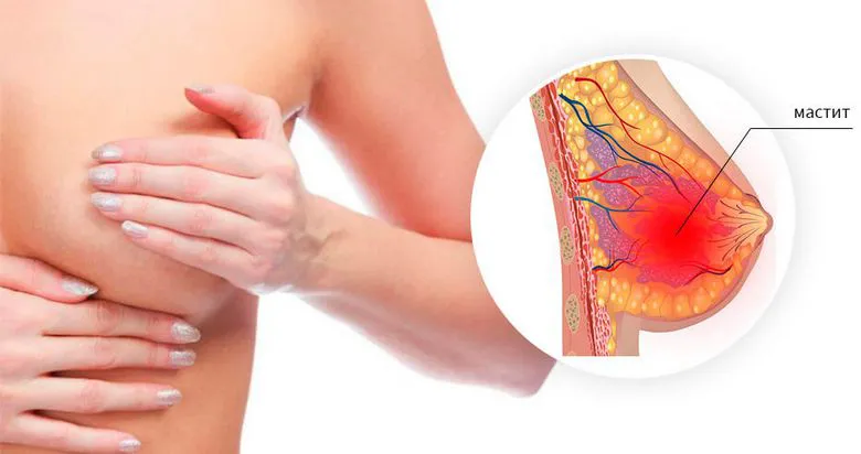 Боль в груди - симптомы мастопатии