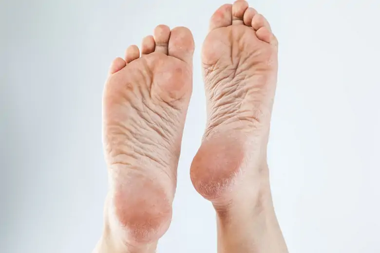 Мозоли натоптыши сухость кожи ног